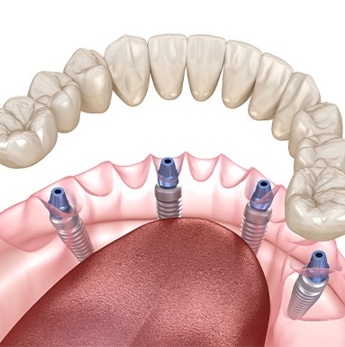 Example of All-on-4 Dentures in Soldotna