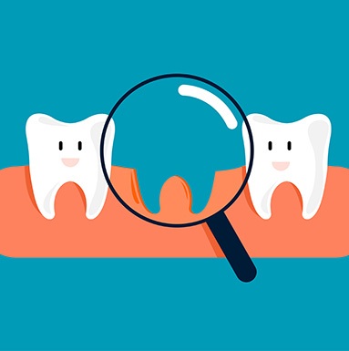 Illustration of a missing tooth