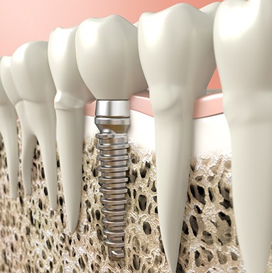 Digital illustration of a dental implant