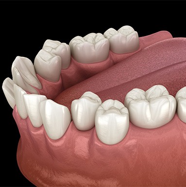 Illustration of crowded teeth