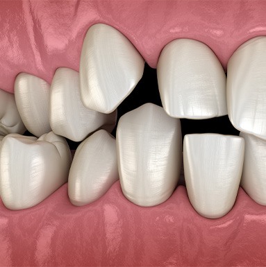 Illustration of gapped teeth