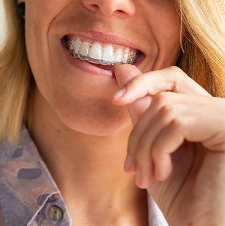 Lady wears clear aligner